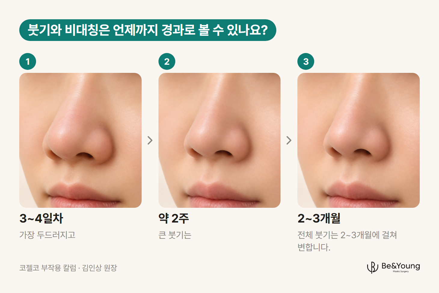 같은 코를 사면에서 본 3~4일차, 약 2주, 2~3개월의 붓기 변화를 나란히 놓은 일러스트