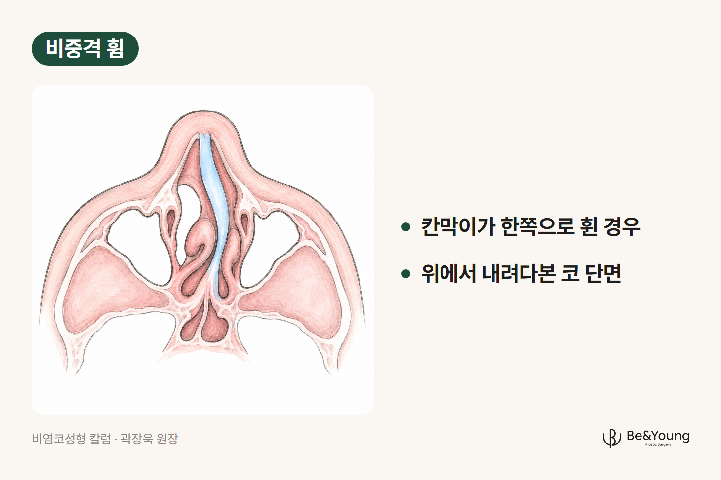 비염 코성형 전 확인할 코막힘 원인인 비중격 휨, 비중격이 한쪽으로 휘어 그쪽 콧속 통로가 좁아진 코를 위에서 내려다본 단면 손그림