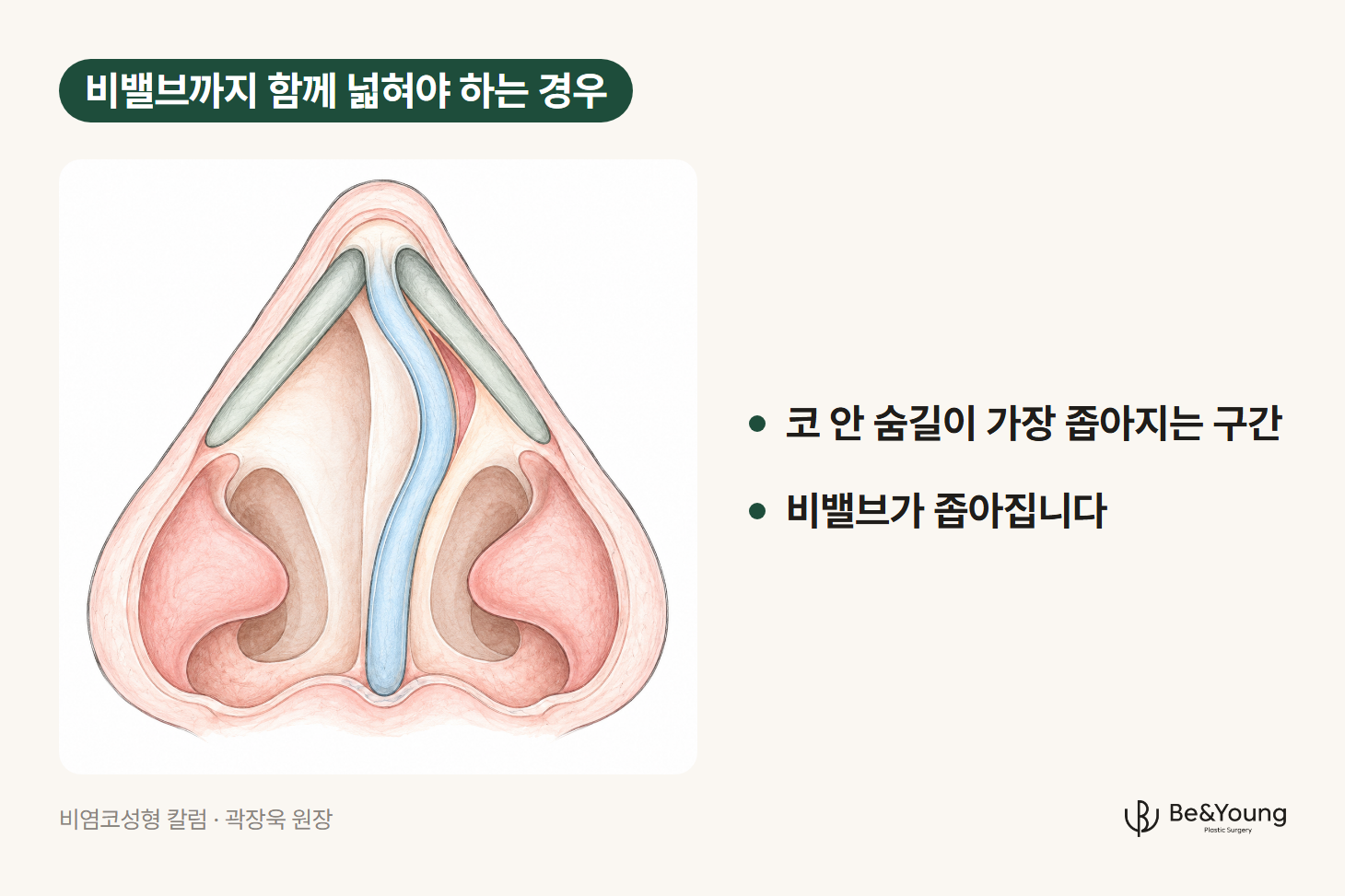 비염 코성형에서 함께 보는 비밸브, 비중격이 휘어 한쪽 비밸브가 좁아진 모습을 앞에서 본 코 단면 손그림