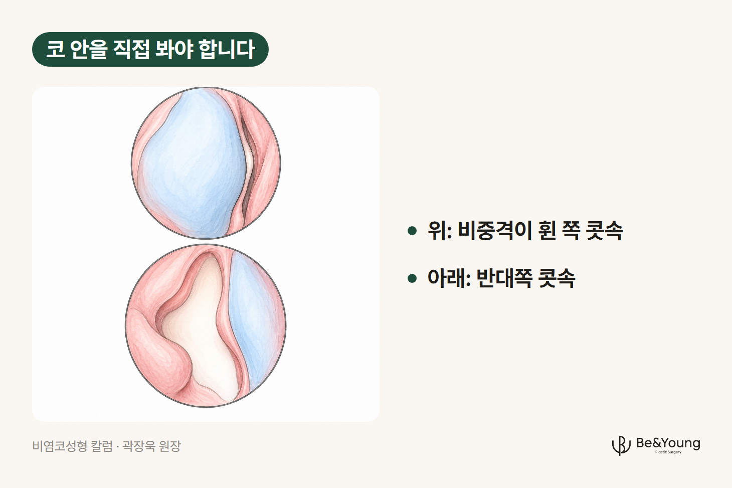 비염 코성형 상담에서 코 안을 직접 보는 이유, 휜 비중격 쪽의 좁은 통로와 반대쪽 넓은 통로를 내시경 화면처럼 그린 손그림