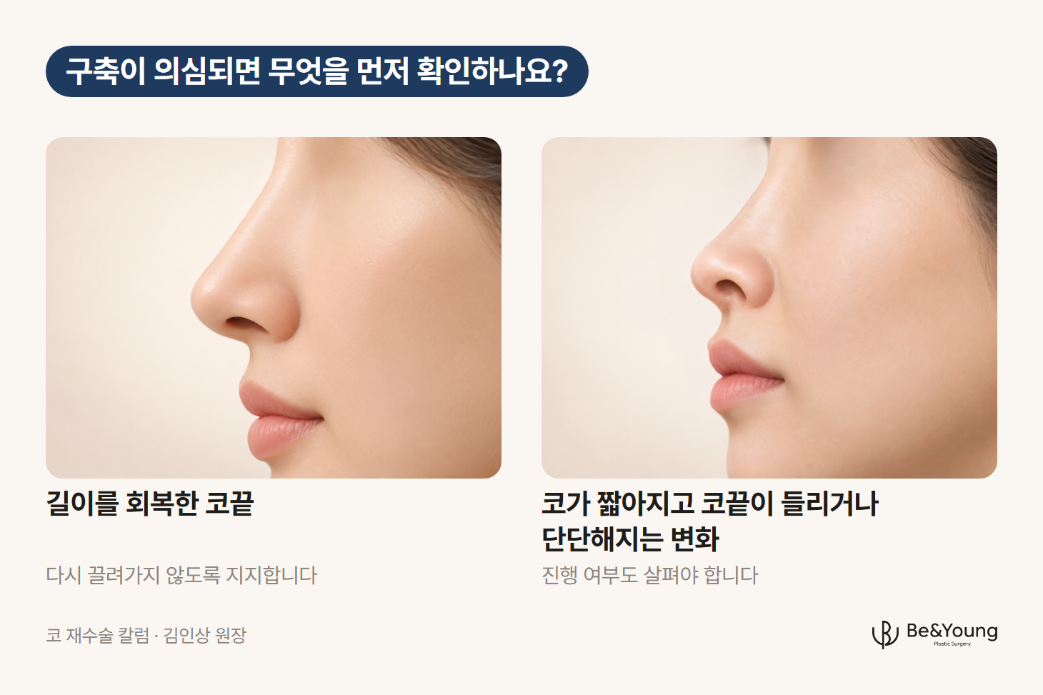 코끝이 지지된 옆모습과 인대조직 수축으로 짧아지고 들린 코끝을 같은 방향과 배율로 비교한 일러스트