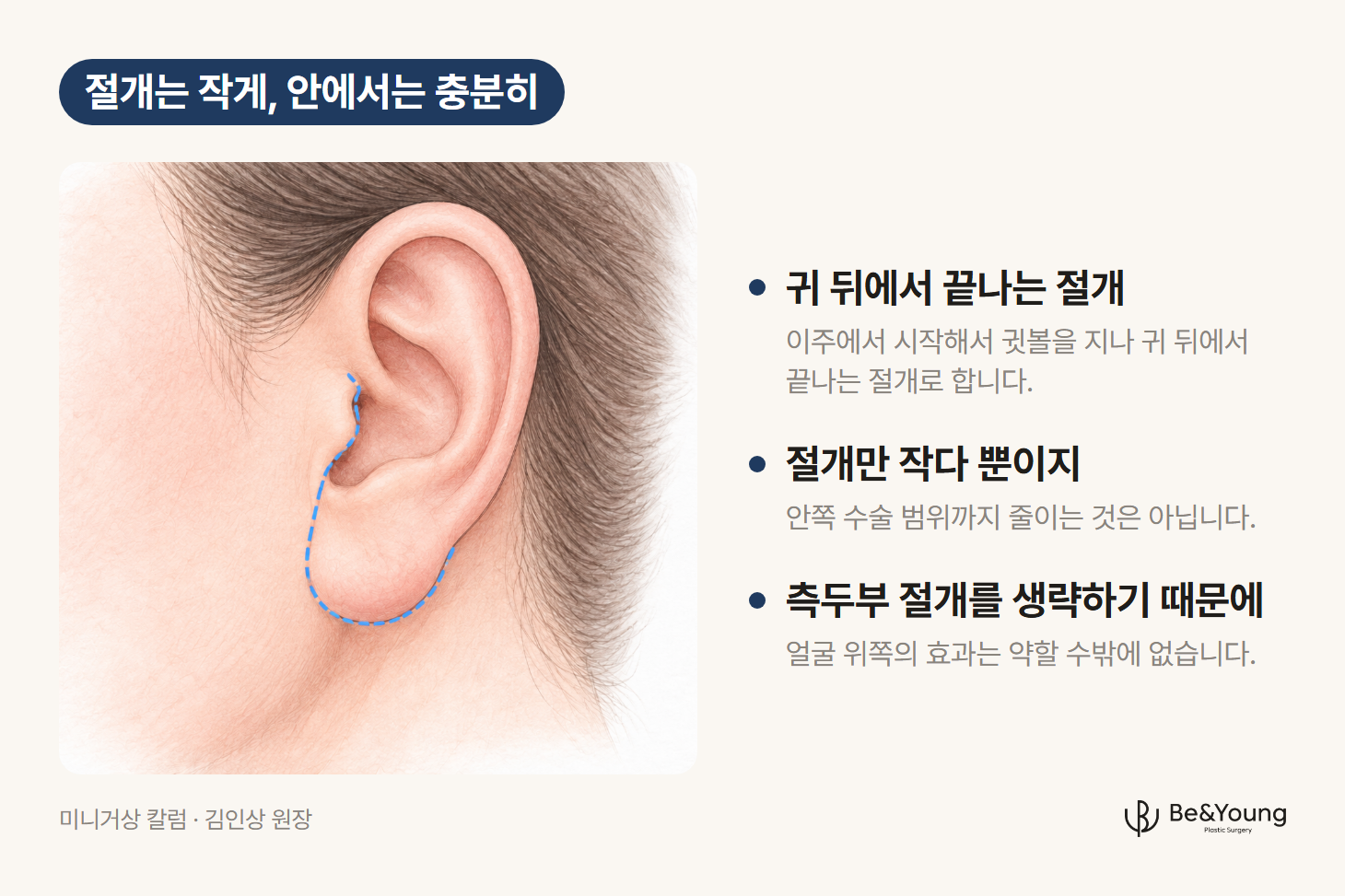 미니거상 절개선을 설명하기 위해, 이주 가장자리를 따라 내려와 귓볼 아래를 돌아 귀 뒤로 이어지는 절개선을 점선으로 표시한 귀 옆모습 손그림