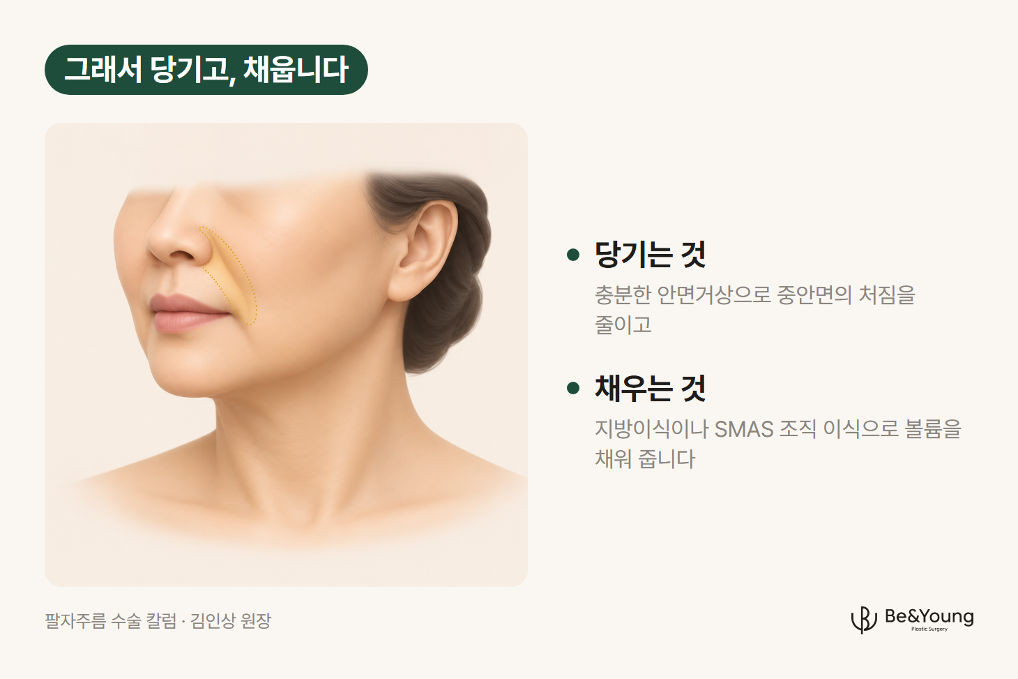 코 옆 팔자주름 부위를 옅은 색으로 표시한 얼굴 아래쪽 그림. 안면거상으로 처짐을 줄이고 꺼진 곳은 지방이식이나 SMAS 조직 이식으로 채운다는 설명