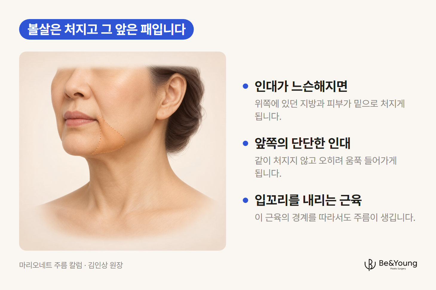 마리오네트 주름, 곧 입꼬리에서 턱으로 내려가는 선과 그 바깥쪽에 처진 볼살을 살구색으로 표시한 얼굴 아래쪽 그림