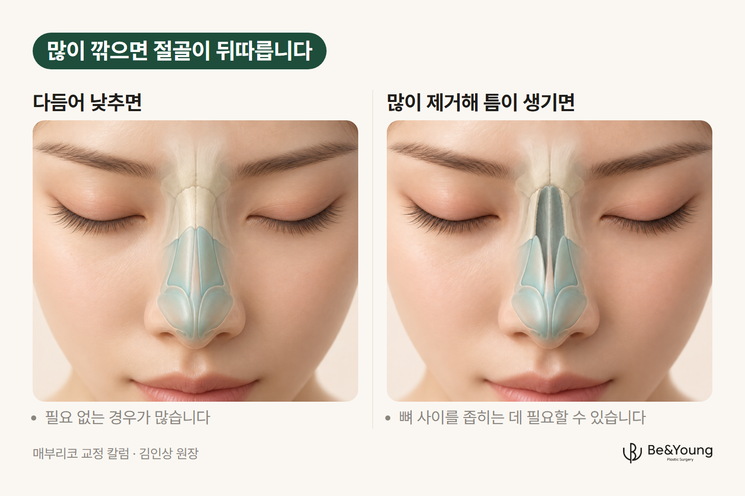 매부리를 다듬어 낮춘 콧등과 많이 제거해 틈이 생긴 콧등을 나란히 비교한 일러스트