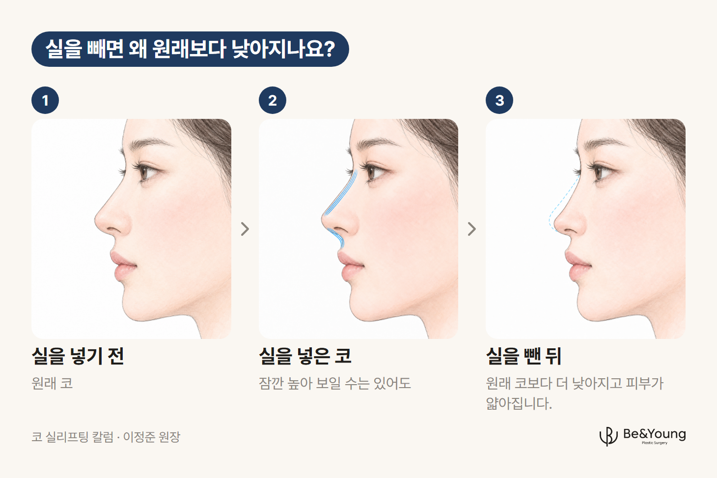 실을 넣기 전 원래 코, 실을 넣은 코, 실을 뺀 뒤 원래 윤곽보다 낮아진 코의 옆모습을 차례로 놓은 손그림