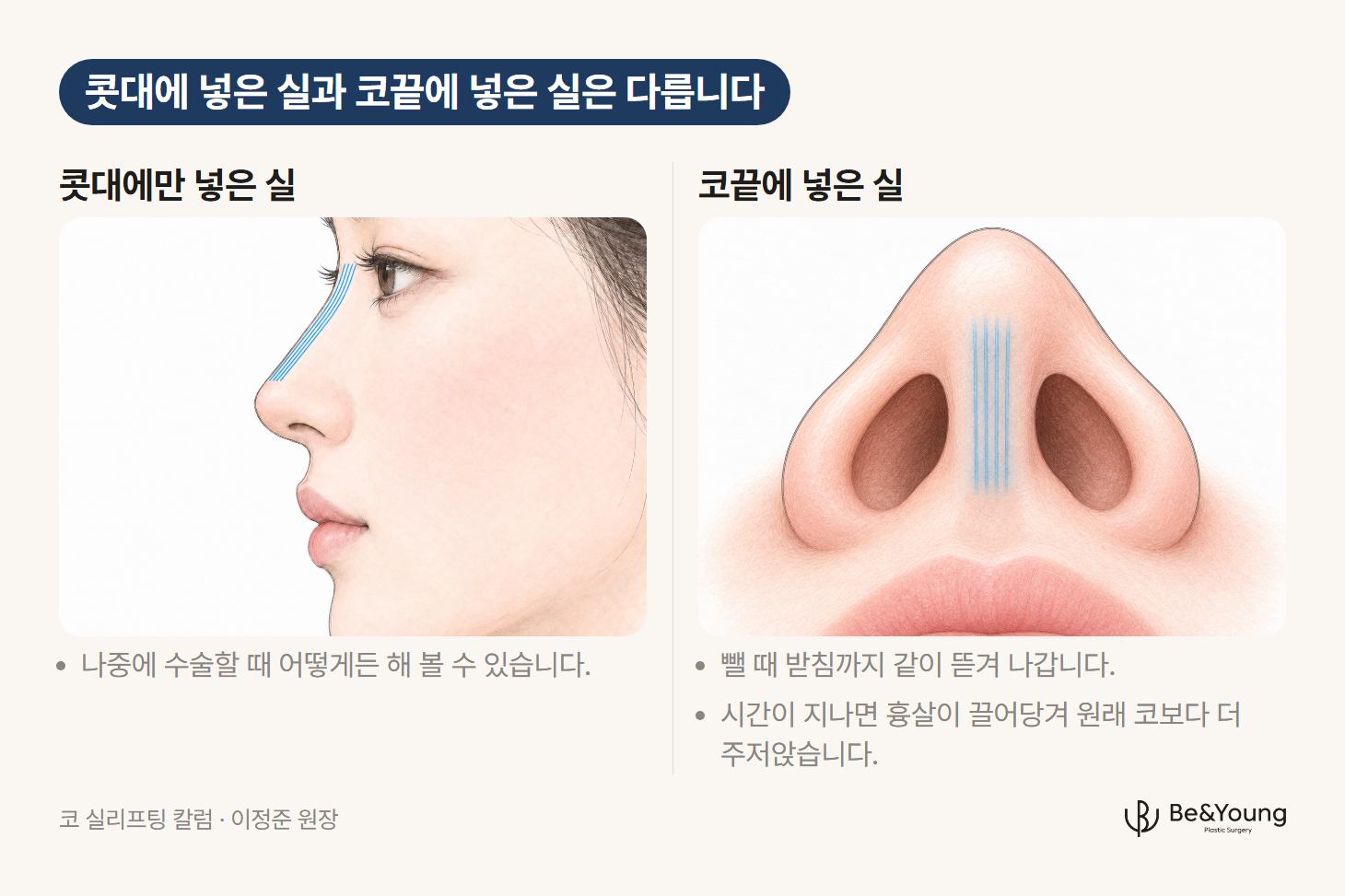 콧대를 따라 넣은 실은 옆모습에, 코끝에서 콧구멍 사이 기둥 속으로 넣은 실은 아래에서 본 모습에 하늘색 선으로 나타낸 손그림