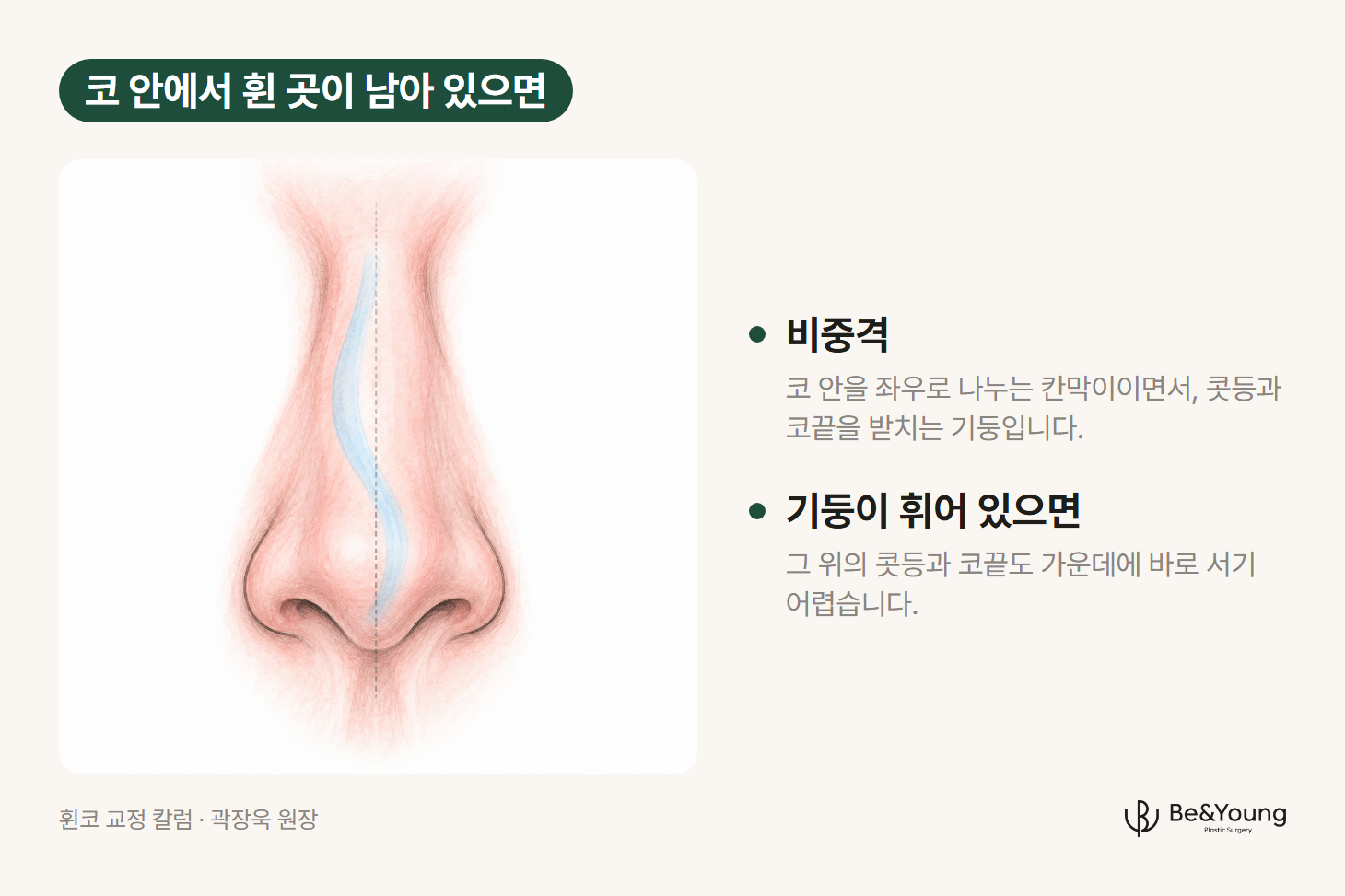 휜코 교정 전 확인할 코 안의 원인, 겉 콧등은 가운데에 있지만 속의 비중격이 휘어 있는 코를 앞에서 본 손그림 도해