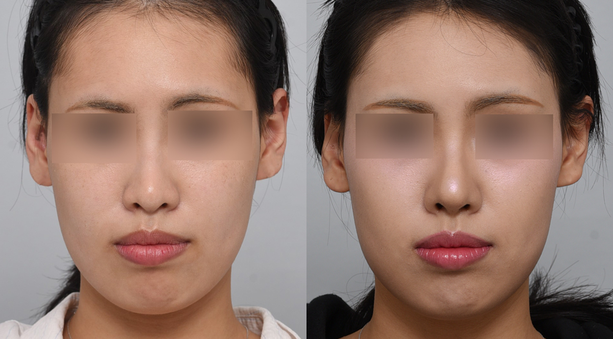 Before 1 Front
