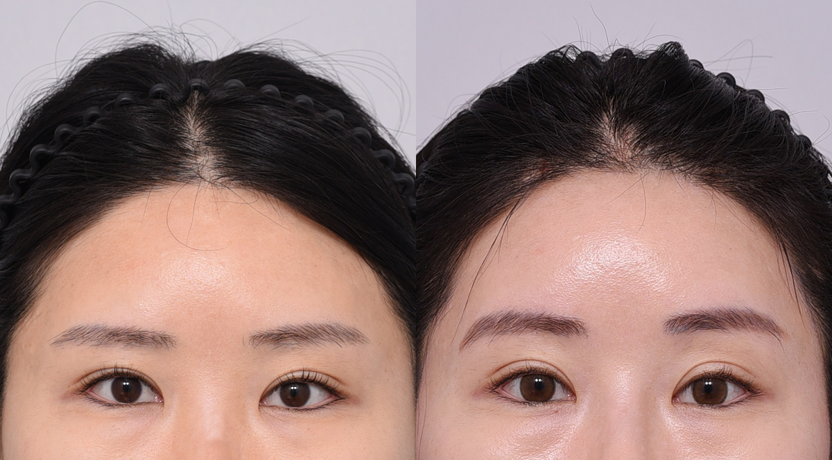 Before 1 Front