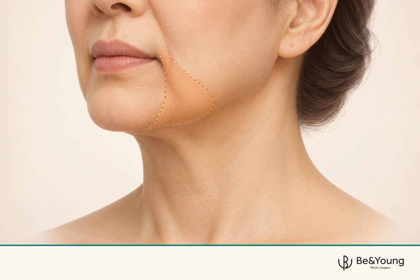 입가 지방을 빼면 마리오네트 주름이 펴질까요?
