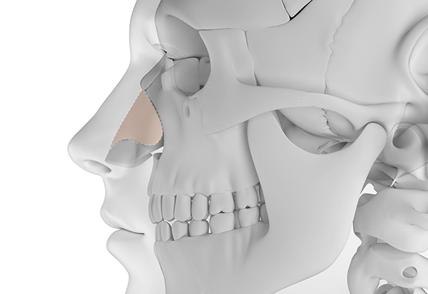 Type-Specific Rhinoplasty