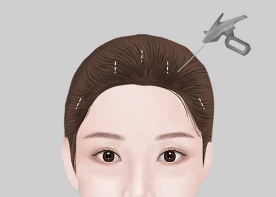 Endoscopic Forehead Lift