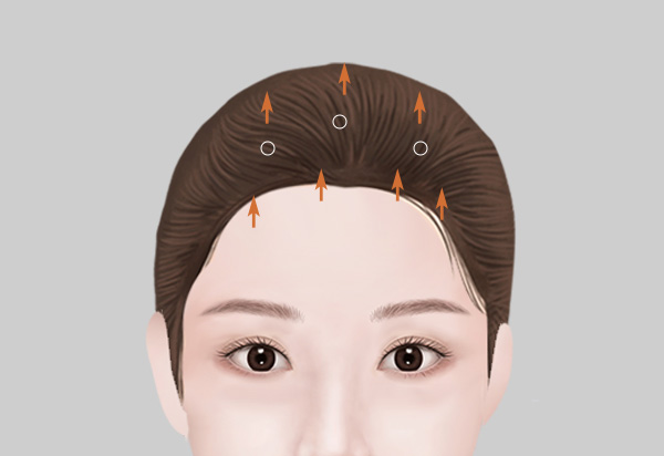 Endoscopic Forehead Lift