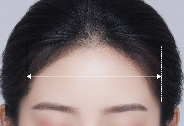 Forehead Reduction + Lift